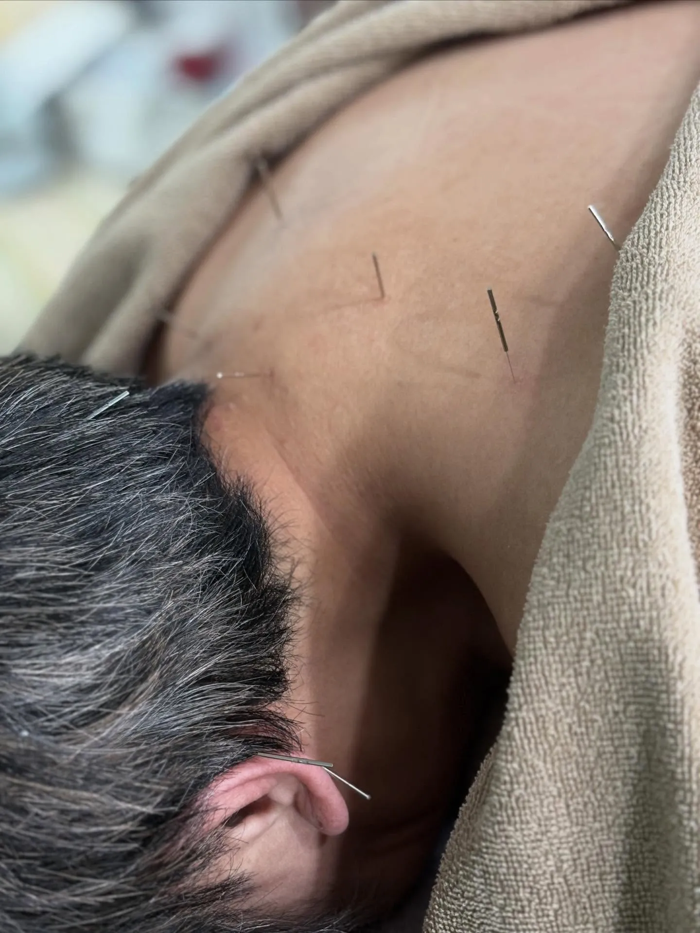 【量子空間で鍼灸施術🪡🔥相乗効果で血流UP】